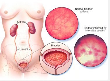 Interstitial Cystitis